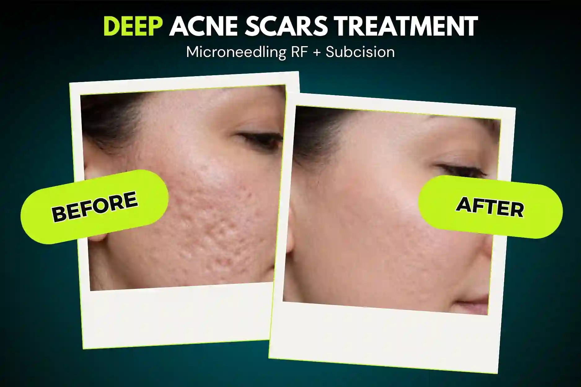 Acne Scar Treatment Before and After Results - SMC Aesthetics Karachi